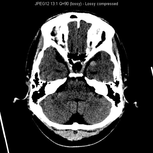 CT Brain - 3